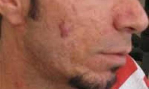 روش های درمان طبیعی آکنه